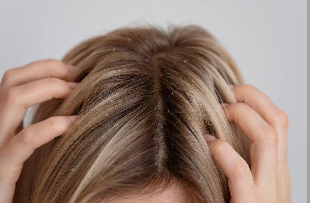 cuidos com o cabelo cuidados capilares inverno mulher caspa como tratar