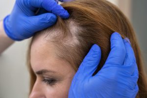 Alopecia: Saiba tudo sobre essa doença.